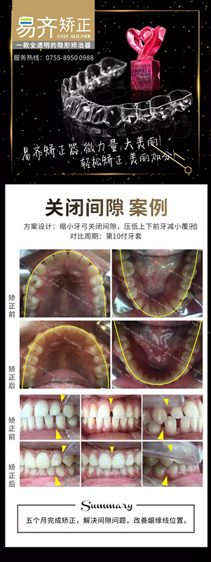牙齿矫正前后对比