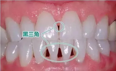 矫正会得黑三角?