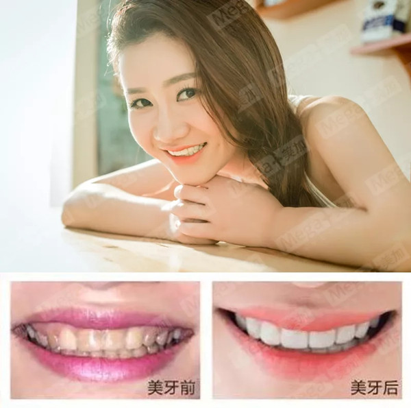 美加贴面案例丨感谢你告诉我,我又美了