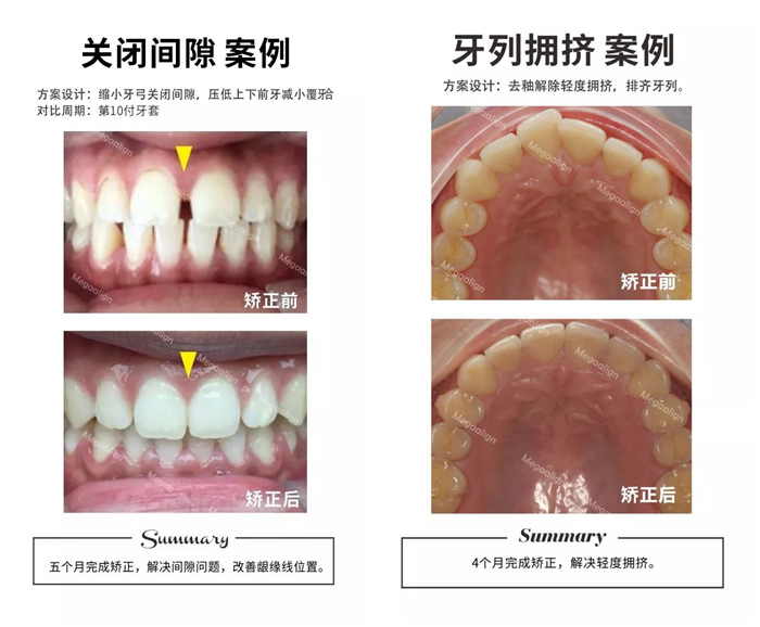 美加易齐微矫案例