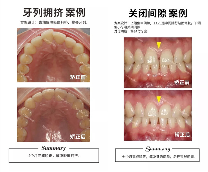 美加易齐微矫案例
