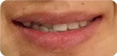 右前牙,右侧切牙反颌,程度较深。
