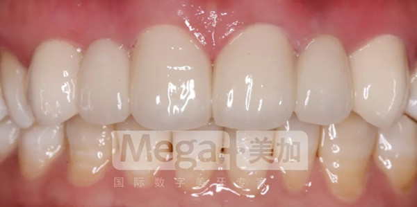 种植牙+贴面修复方案修复后
