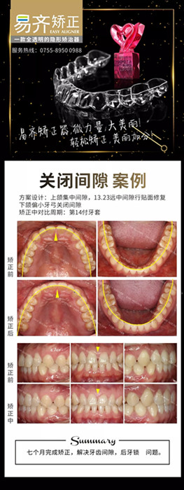 牙齿矫正对比图