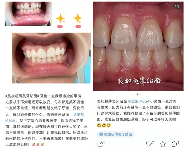 小红书上那么多人在用的美加贴面,我该怎么买?