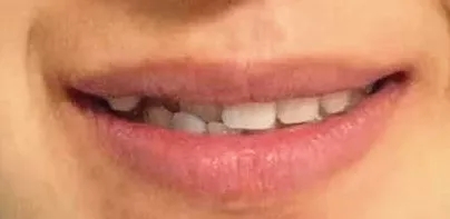 低位笑线露齿量不够,显老态