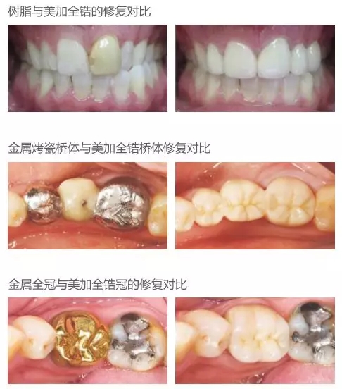 烤瓷牙变黄了,可以拆掉换成牙贴面修复吗?