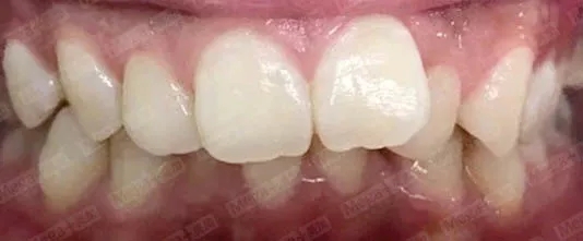 这种牙不齐用易齐矫正也可以排齐!