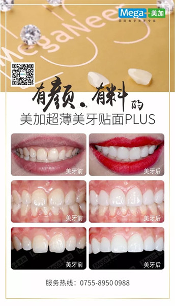 美加贴面plus美牙案例展示,揭秘高端美齿之选