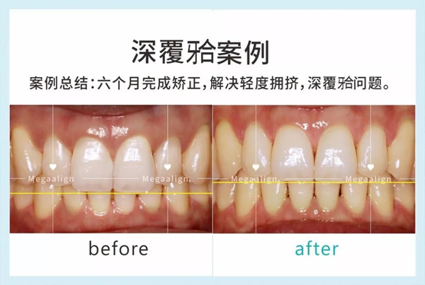 美加易齐微矫，成年人的隐形矫正方案