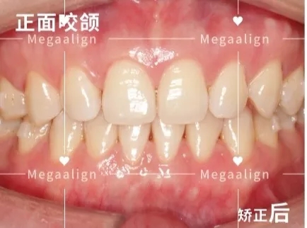 易齐微矫后效果
