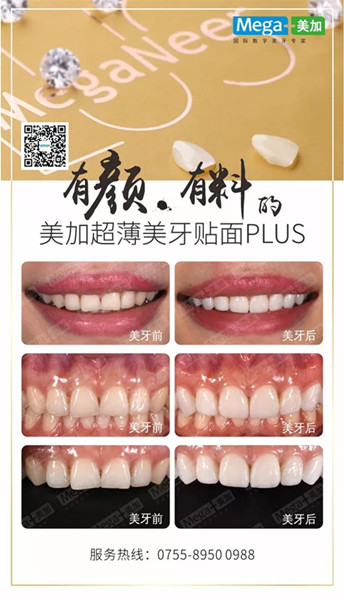 美加贴面plus美牙案例展示,揭秘高端美齿之选