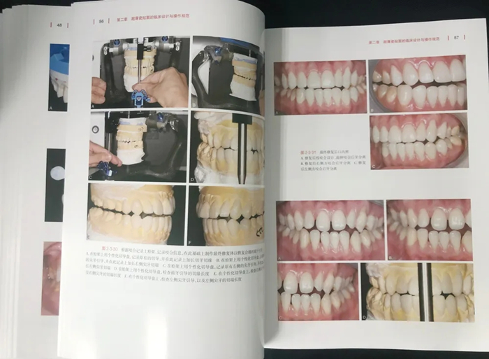 《超薄瓷贴面美学修复》这本贴面宝典你值得拥有!