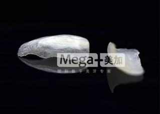 瓷贴面怎么做的