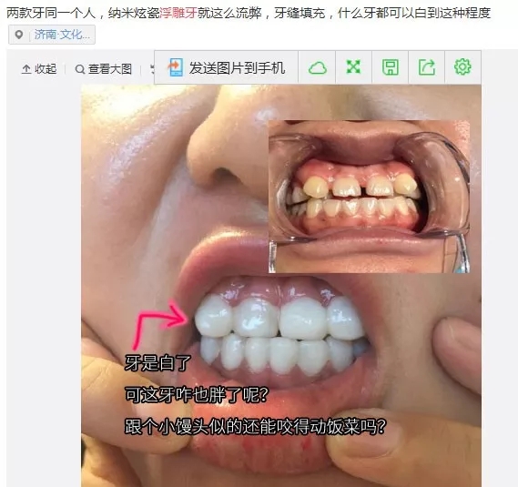 牙贴面花名多,被骗的可不少,科普一波全瓷贴面小知识