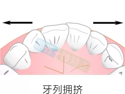 易齐微矫正方案:牙列拥挤