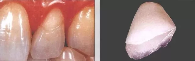 瓷贴面修复后的该如何维护?