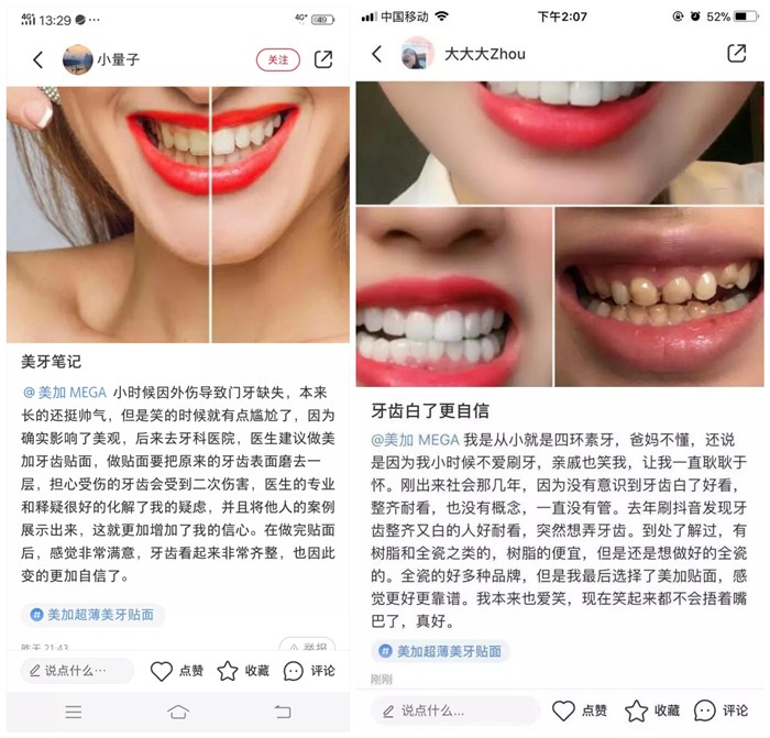 瓷贴面修复后的该如何维护?