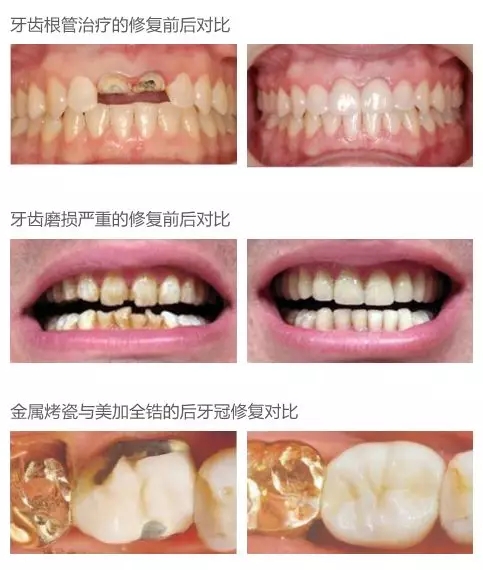 烤瓷牙变黄了,可以拆掉换成牙贴面修复吗?