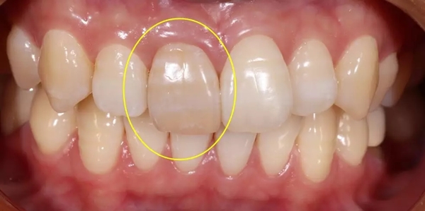 变色了的死髓牙能用牙齿贴面来美白吗?