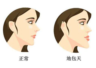 地包天怎么矫正