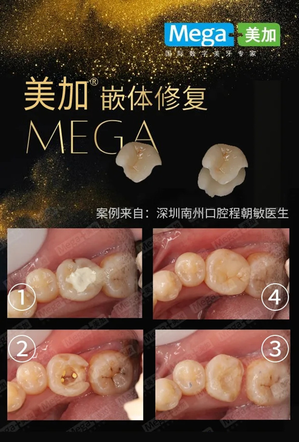 美加嵌体修复病例