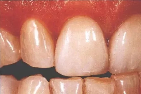瓷贴面修复后的该如何维护?