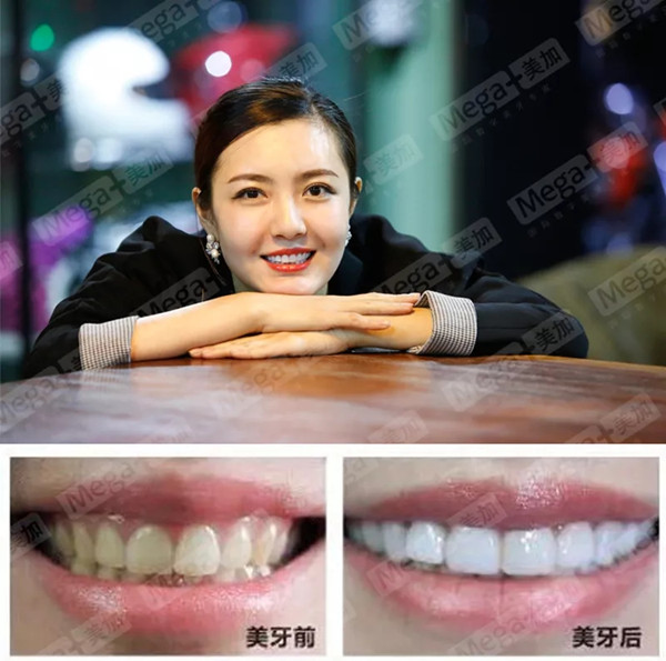 美加贴面案例丨感谢你告诉我,我又美了
