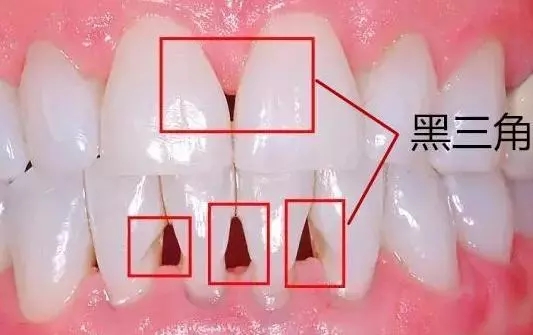 矫正后牙齿出现了黑三角,我该怎么办?