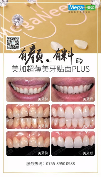 美加贴面plus美牙案例展示,揭秘高端美齿之选