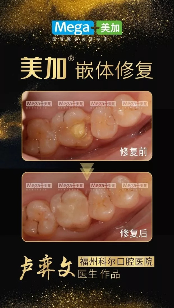 使用美加嵌体修复案例