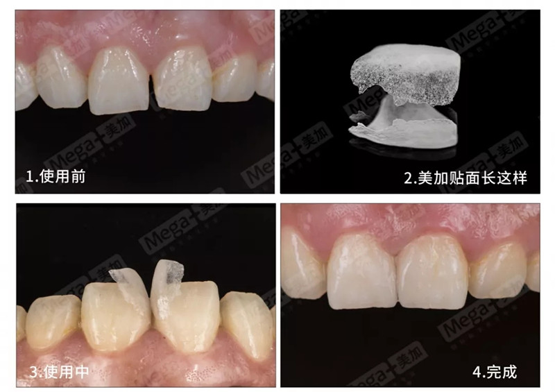 美加瓷贴面关闭牙缝隙