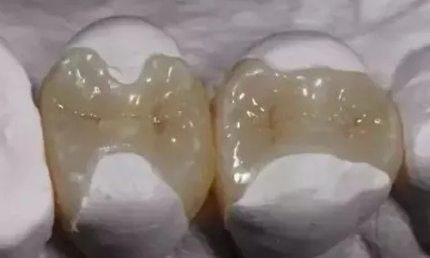 对自己要好点,用美加全瓷嵌体补牙的好处