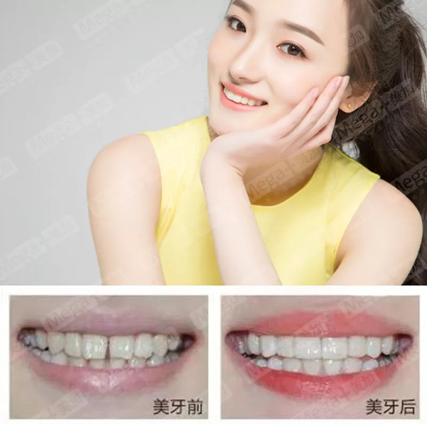 美加贴面案例丨感谢你告诉我,我又美了