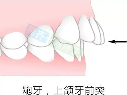 ★ 深覆盖,2mm以内内收 ★