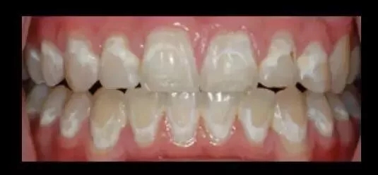 牙齿矫正完牙齿上面有白斑,怎么有效预防?