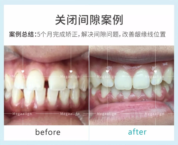 美加易齐微矫案例
