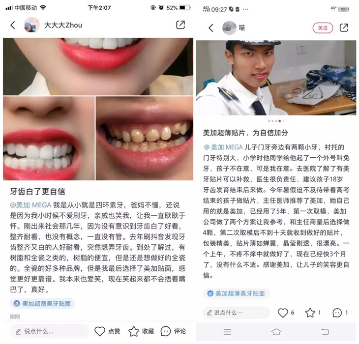 为什么他们都愿意在小红书上种草美加贴面?