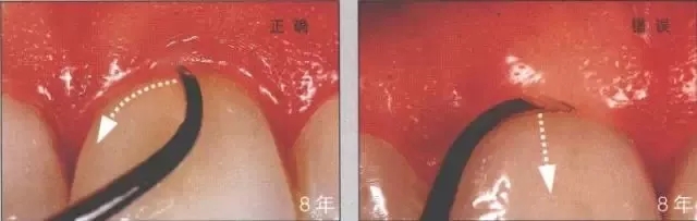 瓷贴面修复后的该如何维护?
