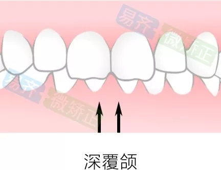 易齐微矫正方案:深覆颌