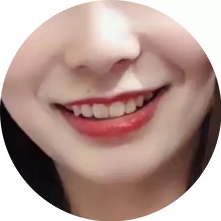 美牙故事分享:美加易齐透明矫正后,口红终于不用压箱底啦!