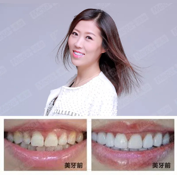 美加贴面案例丨感谢你告诉我,我又美了