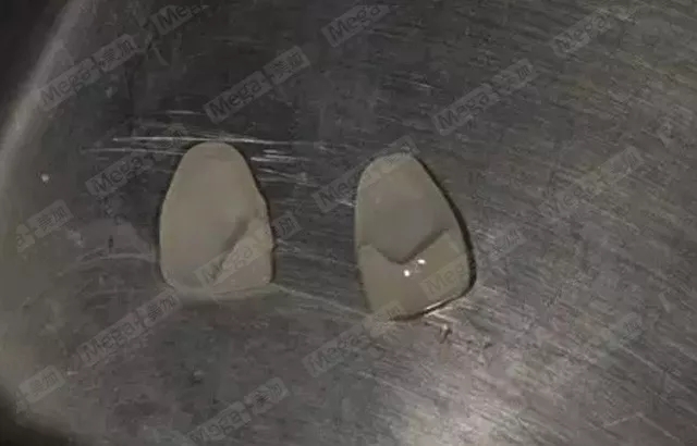 美加案例丨牙齿缺损,美加瓷贴面修复案例一则