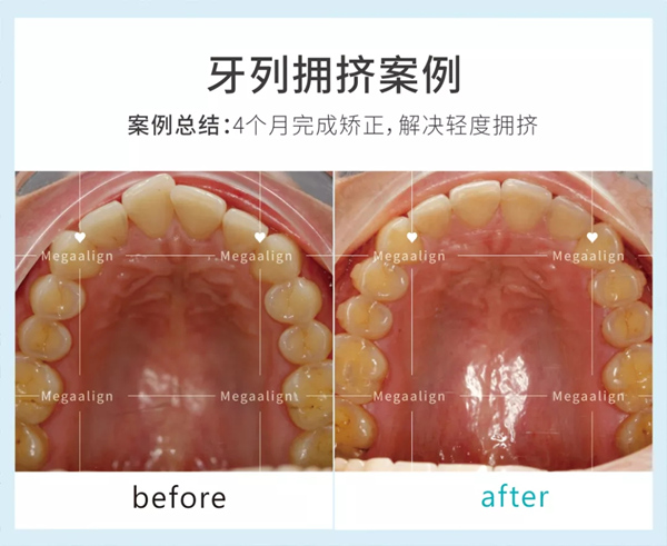 美加易齐微矫，成年人的隐形矫正方案