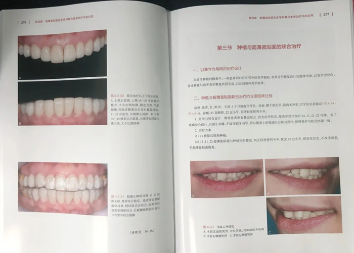 《超薄瓷贴面美学修复》这本贴面宝典你值得拥有!