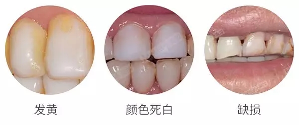 树脂贴面容易着色,形态会有缺损