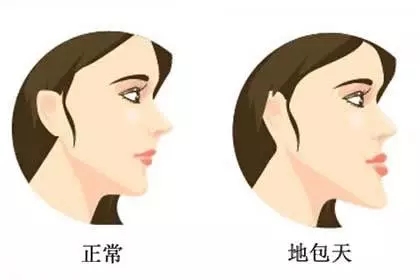 后排出轨,地包天、月牙脸