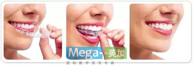 为什么叫隐形矫正