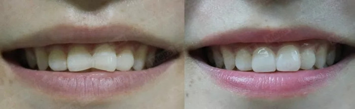 没有对比就没有伤害,美加贴面的魔力