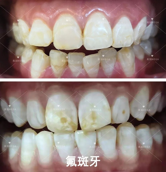 美加贴面修复氟斑牙后太惊艳,你不要试试吗?
